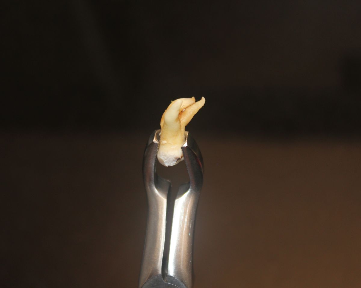 Tooth Extraction in Ahmedabad: What Actually Happens (And Why It's Less Scary Than Google Makes It Sound)